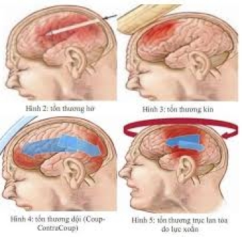 Vết thương sọ não (Dành cho sinh viên Y4)