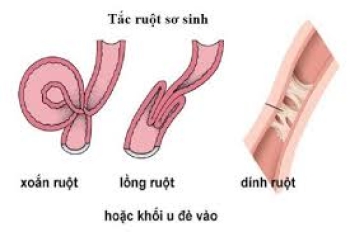 Hội chứng tắc ruột sơ sinh (Dành cho sinh viên Y4)
