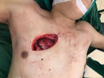 Vết thương ngực hở (Dành cho sinh viên Y4)