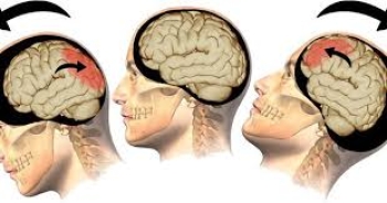 Chấn thương sọ não (Dành cho sinh viên Y4)