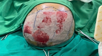 Báo cáo ca lâm sàng: ghép da mỏng vùng đầu cho thân dương vật trên nền đái tháo đường