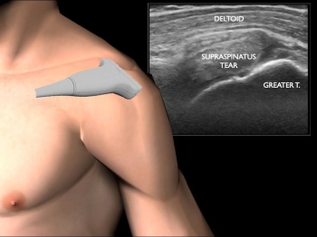 Bài giảng-Siêu âm khớp vai động