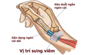 Bài giảng-HPMU-Hội chứng De Quervain