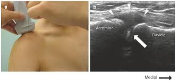 Bài giảng-HPMU-Siêu âm can thiệp dưới siêu âm khớp vai