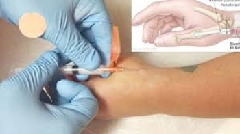 Bài giảng-HPMU-Kỹ thuật tiêm điểm bám gân mỏm trâm quay