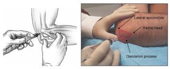 Bài giảng-HPMU-Kỹ thuật tiêm khớp khuỷu và khớp cổ tay