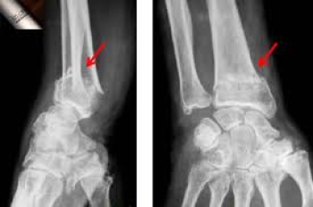 3D-Gãy đầu dưới xương quay kiểu Colles-Nắn chỉnh, bó bột