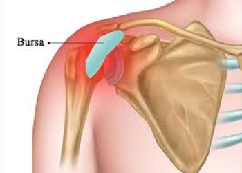 3D-Viêm bao hoạt dịch khớp vai (Shoulder Bursitis / Bursitis of the Shoulder)