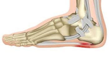 3D-Viêm cân gan chân (Plantar Fasciitis / Plantar Fasciopathy)
