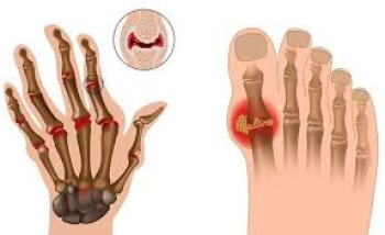 3D-Viêm đa khớp dạng thấp (Rheumatoid Arthritis – RA)