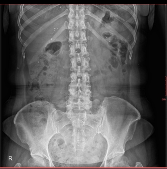 Cần phân biệt bệnh ấu trùng và bệnh lý cơ xương khớp